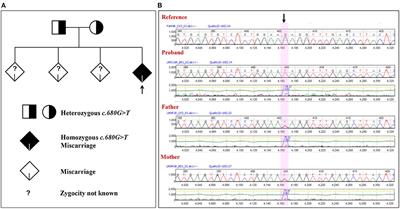 Whole-Genome Sequencing Reveals Exonic Variation of ASIC5 Gene Results in Recurrent Pregnancy Loss